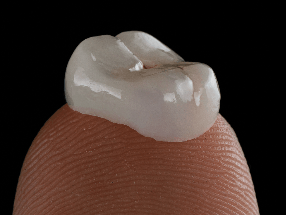 Dental crowns in playa del carmen restoration examples
