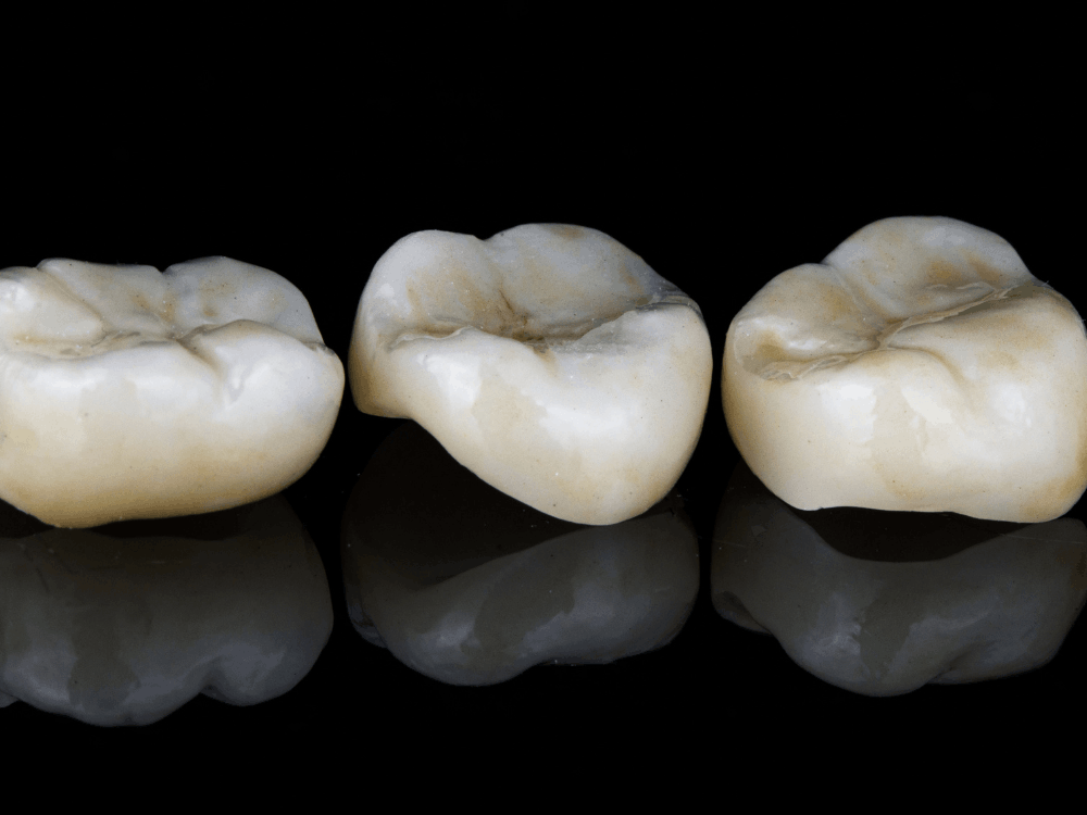 Dental crown in playa del carmen close up restoration