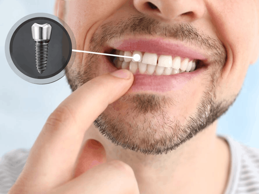 Consulta de implantes dentales en México