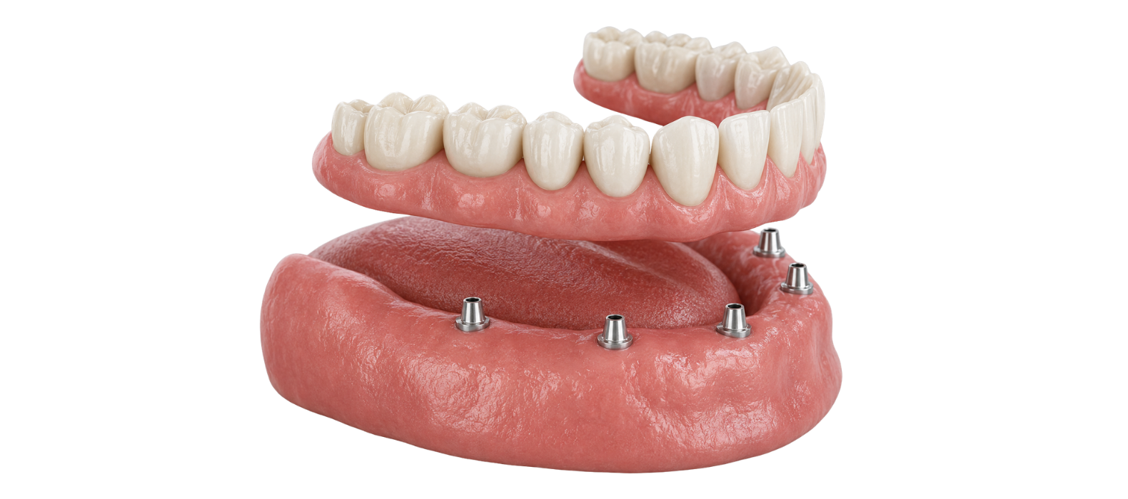 FULL MOUTH DENTAL IMPLANTS