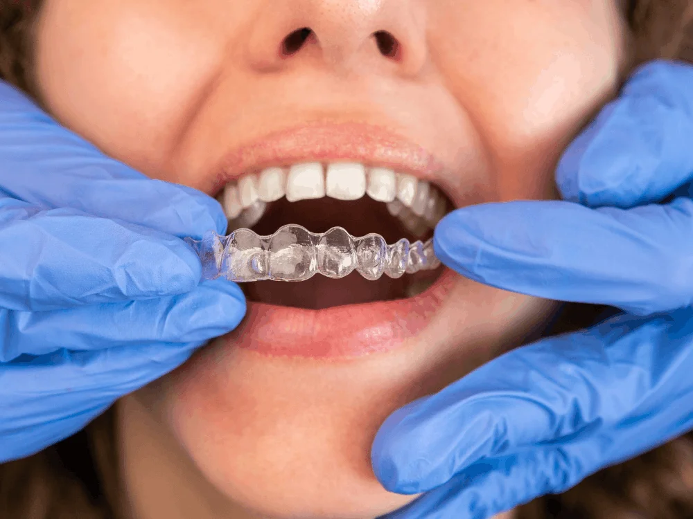 Invisalign candidate evaluation