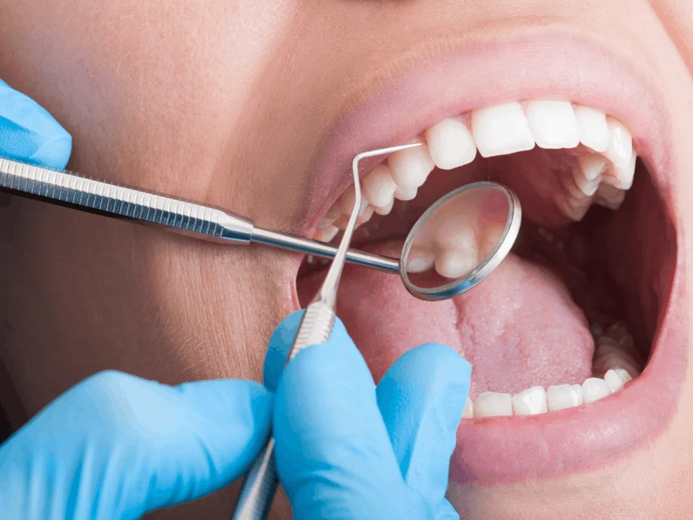 Professional teeth cleaning in Playa del Carmen