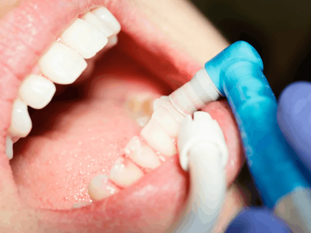Dental hygiene consultation in Mexico