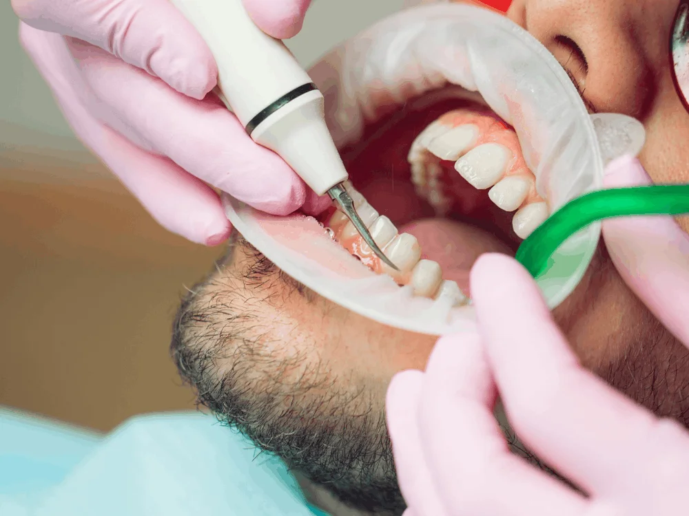Teeth cleaning as a foundation for dental health