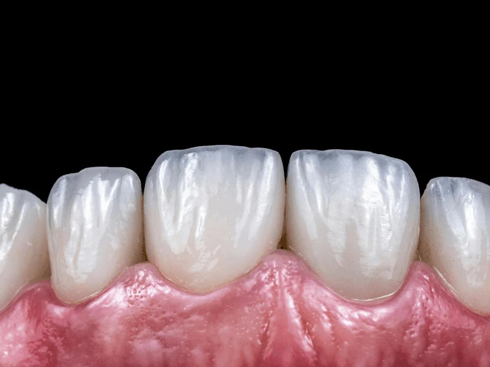 Porcelain veneers close up teeth natural cosmetic dental results Playa del Carmen