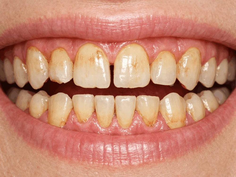 Stained and discolored teeth before porcelain veneers treatment Playa del Carmen